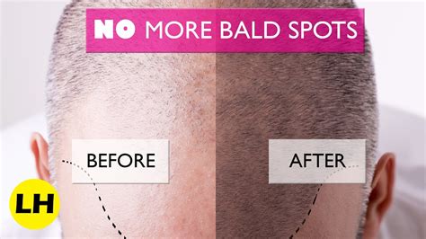 What is the best way to grow bald spots?