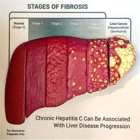 What is the biggest indicator of liver disease?