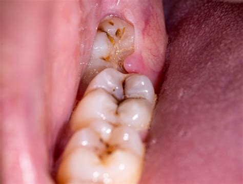 What is the black stuff coming out of my wisdom teeth hole?