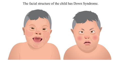 What is the cause of low Down syndrome?