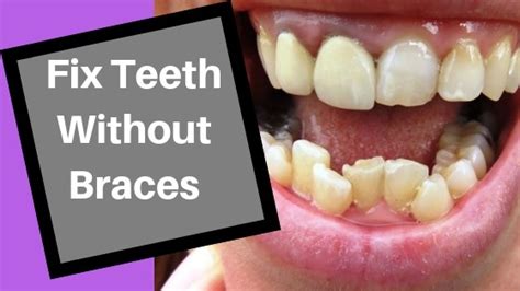 What is the cheapest way to fix teeth without braces?