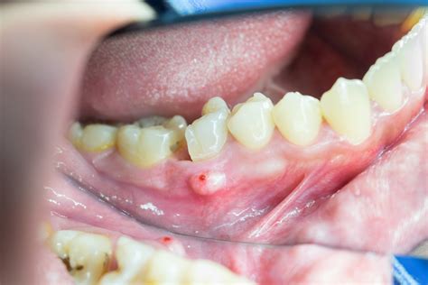 What is the chief complaint of dental abscess?