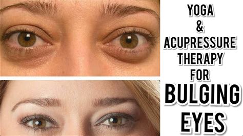 What is the cosmetic treatment for bulging eyes?