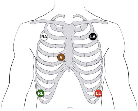 What is the difference between 3 lead and 5 lead?