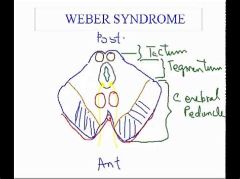 What is the difference between Benedict and Weber syndrome?