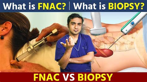 What is the difference between biopsy and FNAC?