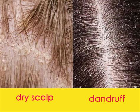 What is the difference between dry scalp and fungus?