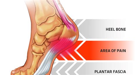 What is the difference between heel pain and plantar fasciitis?