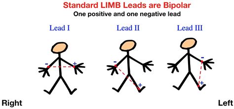 What is the difference between lead 2 and lead 3?