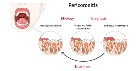 What is the difference between mild and severe pericoronitis?