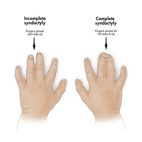 What is the difference between syndactyly and symbrachydactyly?