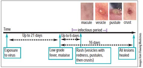What is the duration of pox?