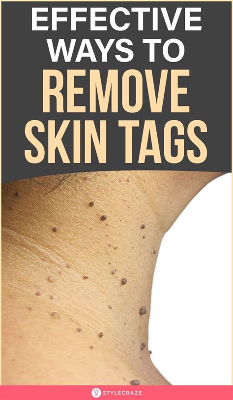 What is the easiest way to remove skin tags at home?