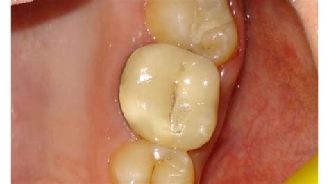 What is the failure rate of dental crowns?
