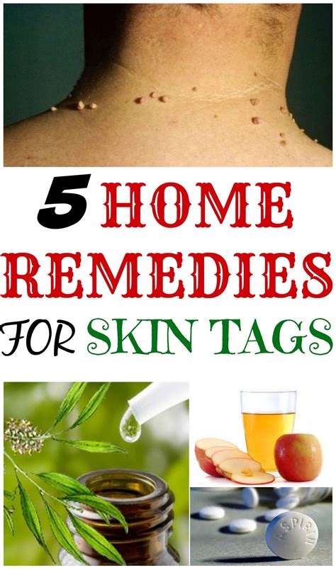 What is the fastest home remedy to remove skin tags?