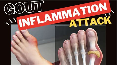 What is the fastest way to flush gout?
