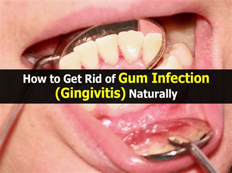 What is the fastest way to get rid of a gum infection?