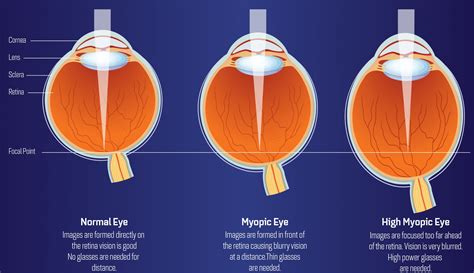 What is the highest myopia?
