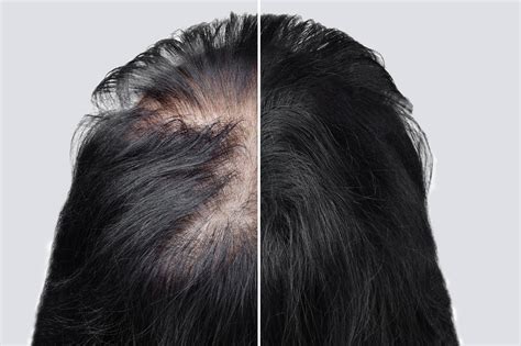 What is the introduction of hair loss?