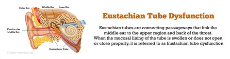 What is the latest treatment for Eustachian tube dysfunction?