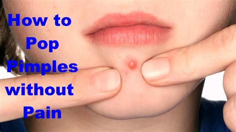What is the least painful way to pop a pimple?