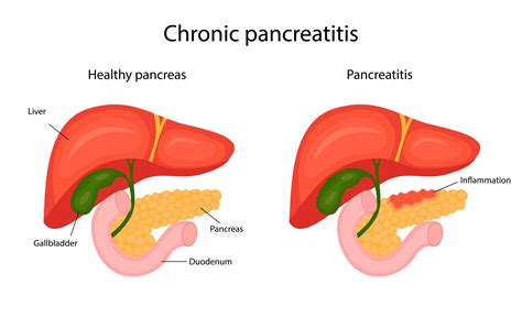 What is the life expectancy with acute pancreatitis?