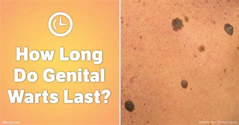 What is the longest genital wart that lasts?