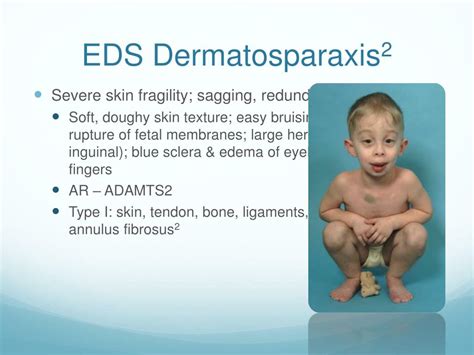 What is the mildest form of EDS?