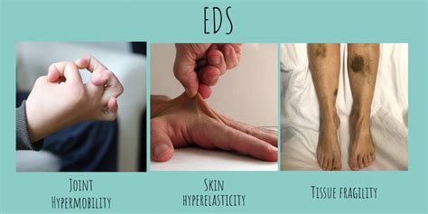 What is the mildest form of Ehlers-Danlos?