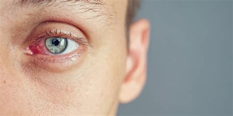 What is the most common bacterial cause of eye infection?