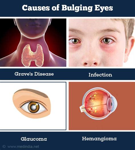 What is the most common cause of bulging eyes?