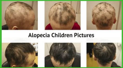 What is the most common cause of hair loss in children?