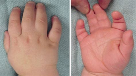 What is the most common cause of syndactyly?