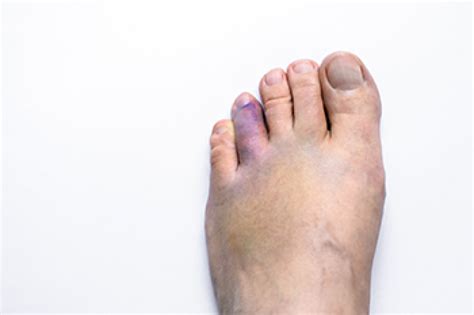 What is the most common toe to break?