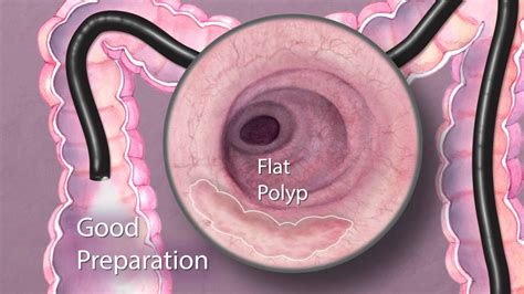 What is the most difficult part of a colonoscopy?
