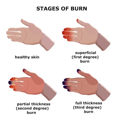 What is the most painful stage of a burn?