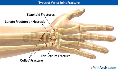 What is the most painful wrist fracture?