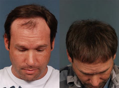 What is the new hair transplant in 2024?