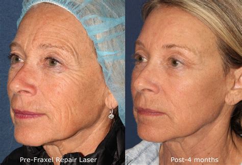 What is the new wrinkle procedure?