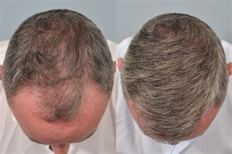 What is the newest hair transplant method in the world?