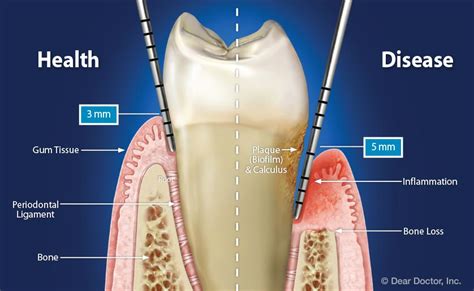What is the normal depth of the periodontal pocket?