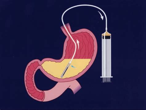 What is the normal gastric residual volume for tube feeding?