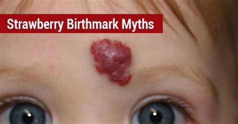 What is the old wives tale about strawberry birthmarks?