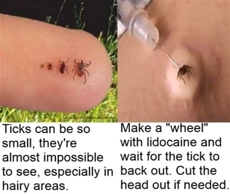 What is the only way to kill a tick?