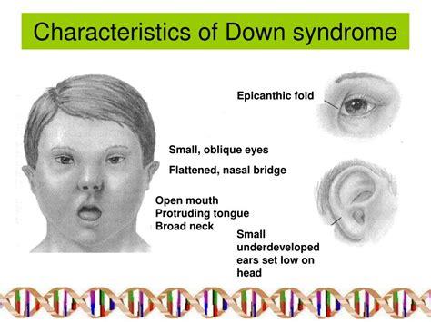What is the opposite of Down syndrome?