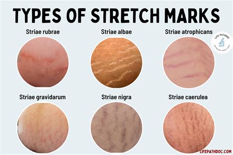 What is the opposite of stretch marks?