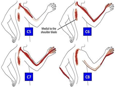 What is the pain pattern for C5-C6?