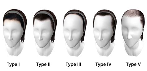 What is the perfect hairline size?