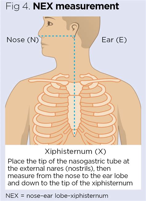 What is the placement of nasogastric tube insertion 2 in adult patients?