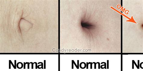 What is the rarest belly button?